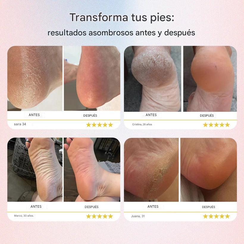 Dermave™ Removedor eléctrico de callos