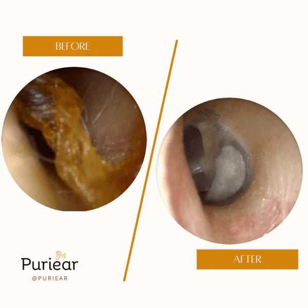 EXTRACTOR DE CERA DE OIDO PURIEAR™