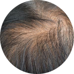 Pérdida de cabello y caída excesiva