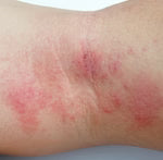 Eczema y psoriasis